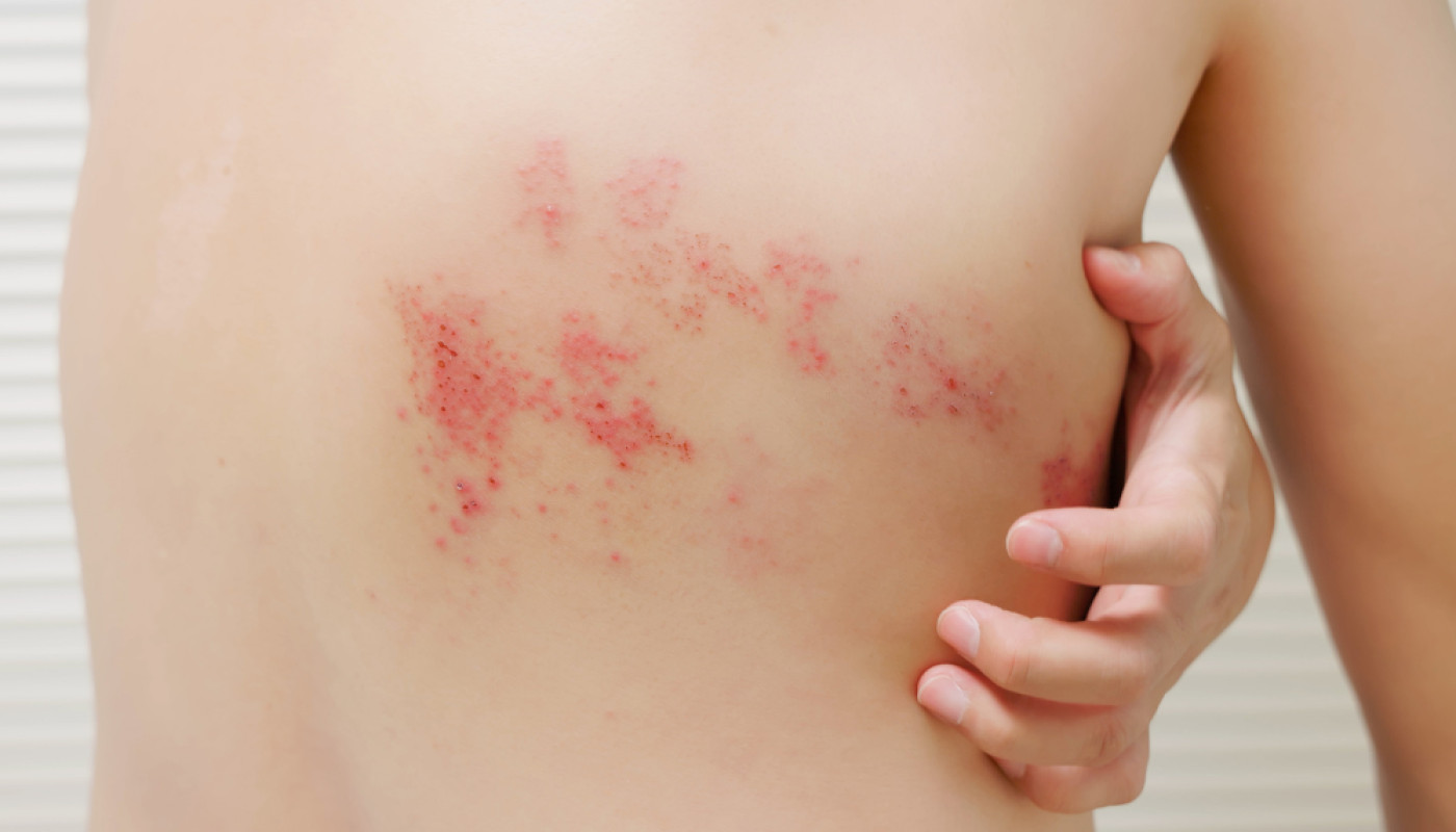 Avez-vous déjà essayé des soins énergétiques pour soulager votre zona ?